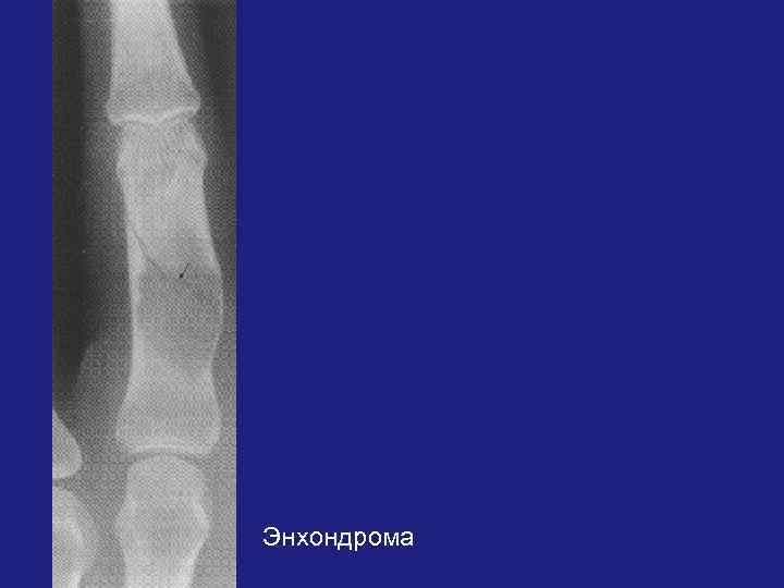 Энхондрома 