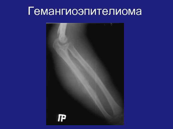 Гемангиоэпителиома 