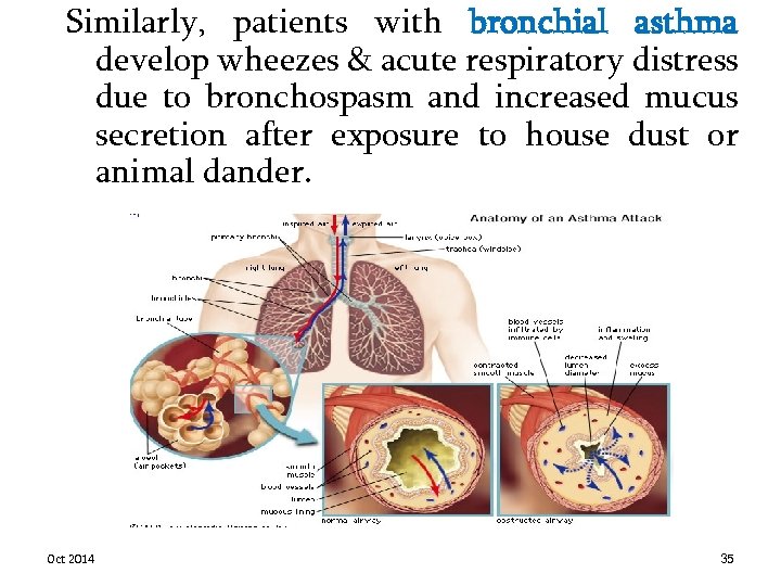 Similarly, patients with bronchial asthma develop wheezes & acute respiratory distress due to bronchospasm