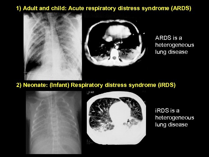 1) Adult and child: Acute respiratory distress syndrome (ARDS) ARDS is a heterogeneous lung