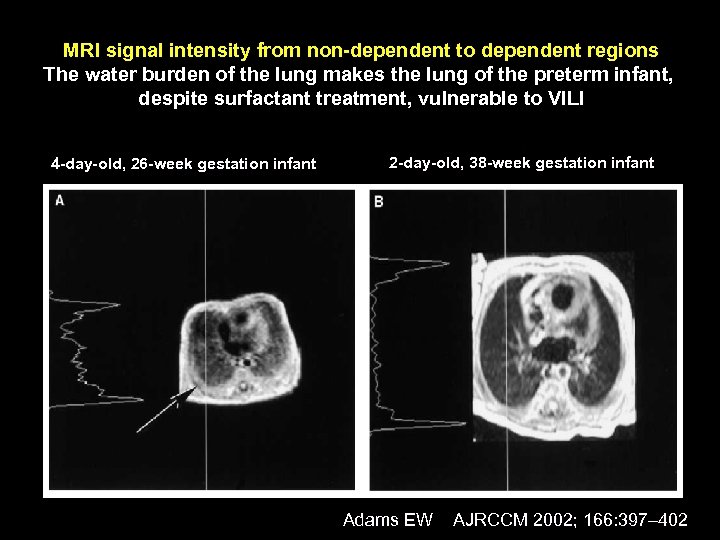 MRI signal intensity from non-dependent to dependent regions The water burden of the lung