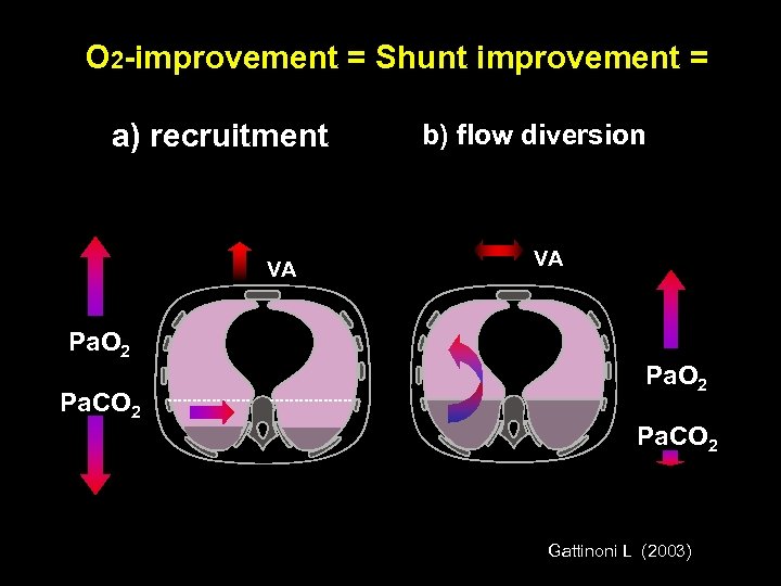 O 2 -improvement = Shunt improvement = a) recruitment VA Pa. O 2 Pa.