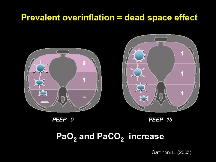 Prevalent overinflation = dead space effect 1 2 1 1 1 – PEEP 0