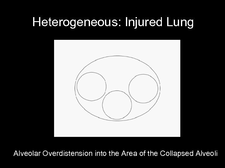 Heterogeneous: Injured Lung Alveolar Overdistension into the Area of the Collapsed Alveoli 