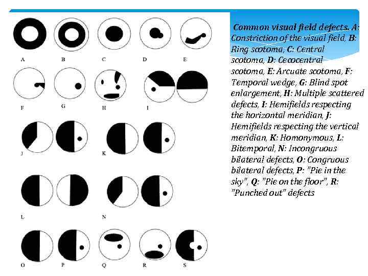  Common visual field defects. A: Constriction of the visual field, B: Ring scotoma,