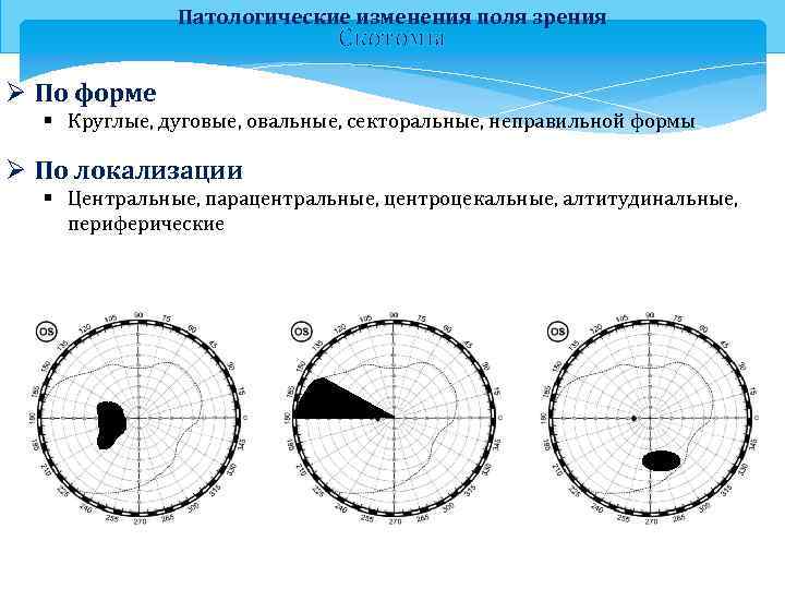 Патологические изменения поля зрения Скотомы Ø По форме § Круглые, дуговые, овальные, секторальные, неправильной