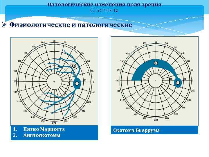 Изменение полей. Скотома Бьеррума. Скотомы классификация. Скотомы полей зрения. Проприоцептивная скотома.