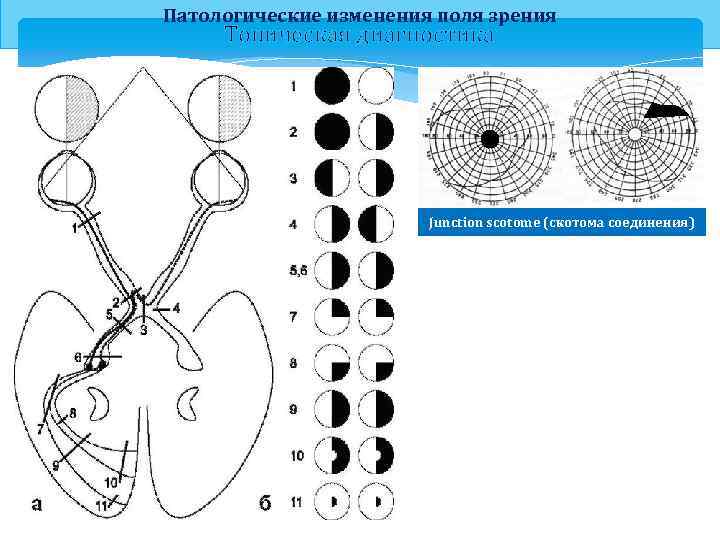 Патологические изменения поля зрения Топическая диагностика Junction scotome (скотома соединения) 