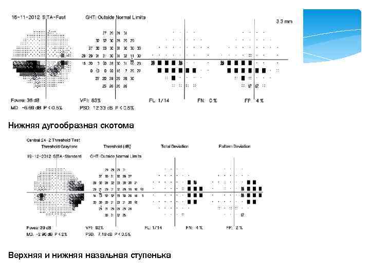 Нижняя дугообразная скотома Верхняя и нижняя назальная ступенька 