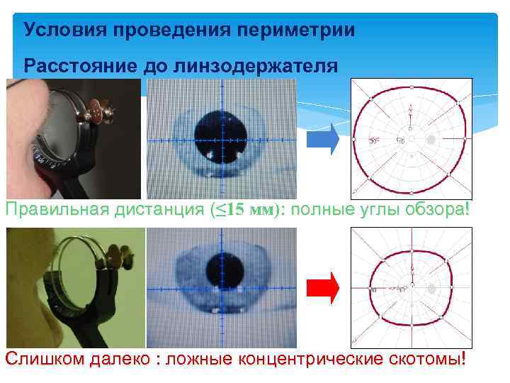 Условия проведения периметрии Расстояние до линзодержателя Правильная дистанция (≤ 15 мм): полные углы обзора!