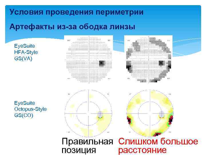 Условия проведения периметрии Артефакты из-за ободка линзы Eye. Suite HFA-Style GS(VA) Eye. Suite Octopus-Style