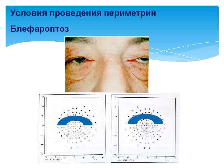 Условия проведения периметрии Блефароптоз 