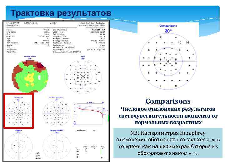 Трактовка результатов Comparisons Числовое отклонение результатов светочувствительности пациента от нормальных возрастных NB! На периметрах