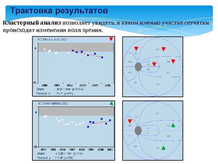 Трактовка результатов Кластерный анализ позволяет увидеть, в каком именно участке сетчатки происходят изменения поля