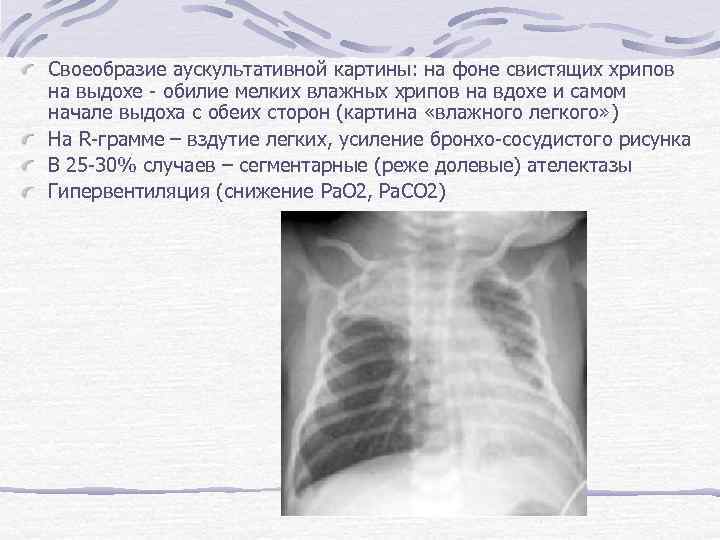 Своеобразие аускультативной картины: на фоне свистящих хрипов на выдохе - обилие мелких влажных хрипов