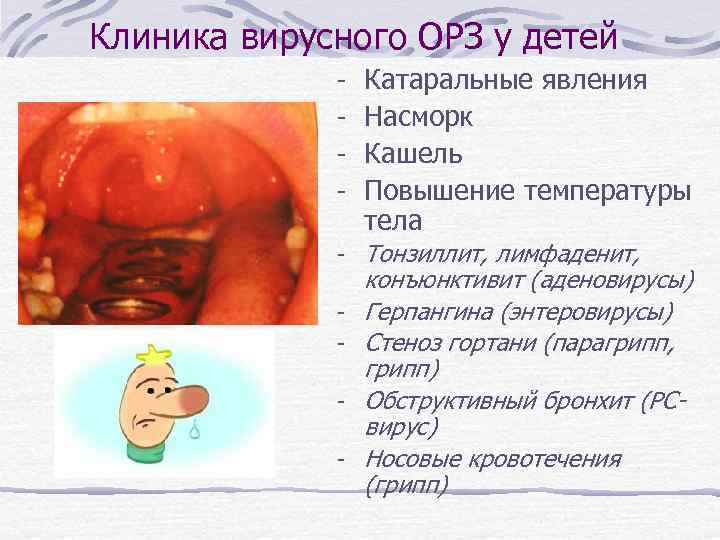Клиника вирусного ОРЗ у детей - Катаральные явления Насморк Кашель Повышение температуры тела -