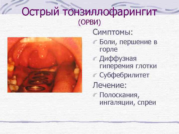 Острый тонзиллофарингит (ОРВИ) Симптомы: Боли, першение в горле Диффузная гиперемия глотки Субфебрилитет Лечение: Полоскания,