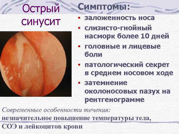 Острый синусит Симптомы: § заложенность носа § слизисто-гнойный насморк более 10 дней § головные