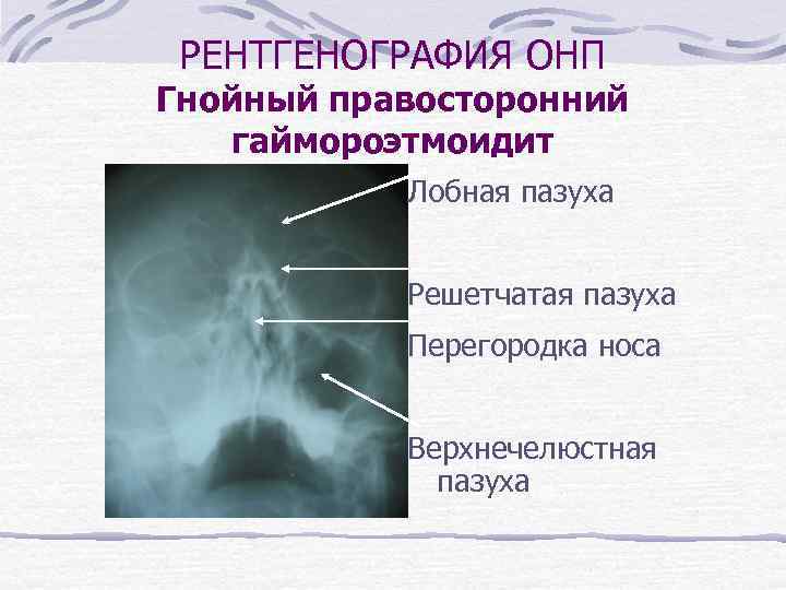 РЕНТГЕНОГРАФИЯ ОНП Гнойный правосторонний гаймороэтмоидит Лобная пазуха Решетчатая пазуха Перегородка носа Верхнечелюстная пазуха 