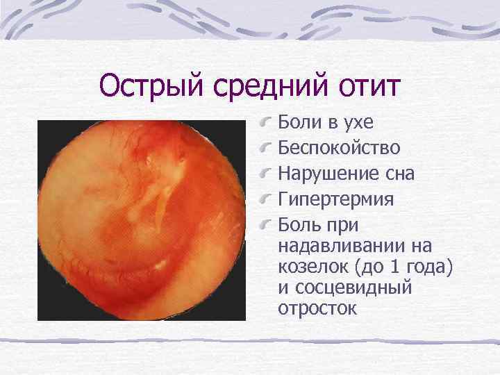 Острый средний отит Боли в ухе Беспокойство Нарушение сна Гипертермия Боль при надавливании на