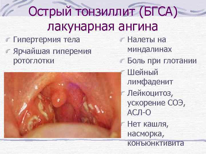 Острый тонзиллит (БГСА) лакунарная ангина Гипертермия тела Ярчайшая гиперемия ротоглотки Налеты на миндалинах Боль