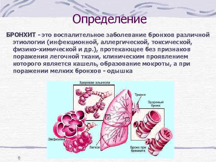 Определение БРОНХИТ - это воспалительное заболевание бронхов различной этиологии (инфекционной, аллергической, токсической, физико-химической и