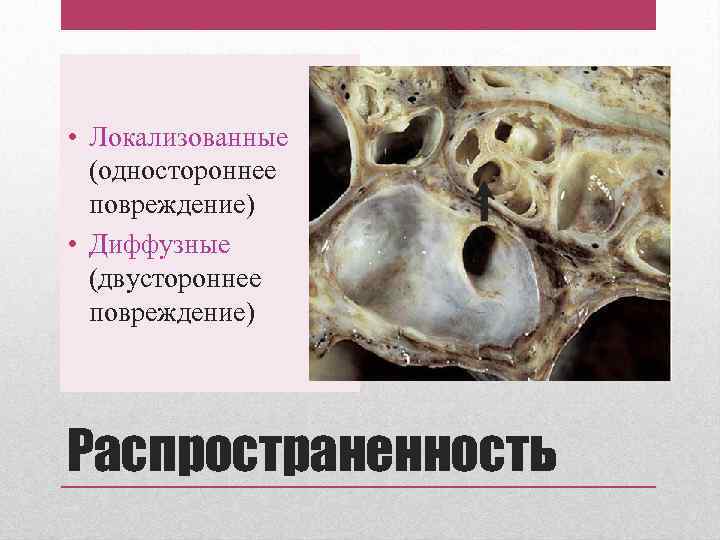  • Локализованные (одностороннее повреждение) • Диффузные (двустороннее повреждение) Распространенность 