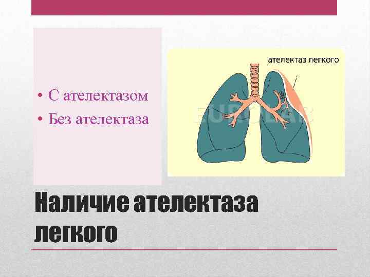  • С ателектазом • Без ателектаза Наличие ателектаза легкого 