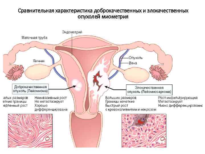 Сравнительная характеристика доброкачественных и злокачественных опухолей миометрия 