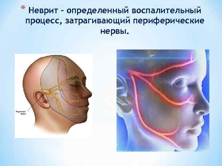 * Неврит - определенный воспалительный процесс, затрагивающий периферические нервы. 