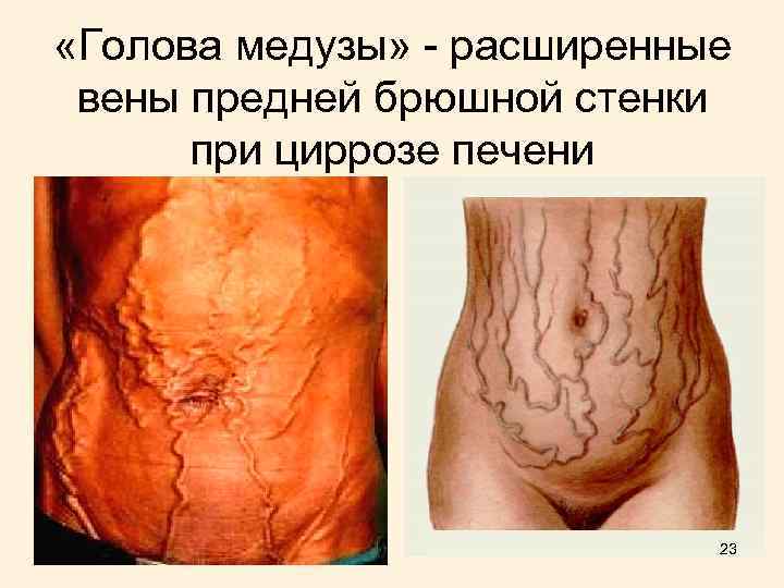  «Голова медузы» - расширенные вены предней брюшной стенки при циррозе печени 23 