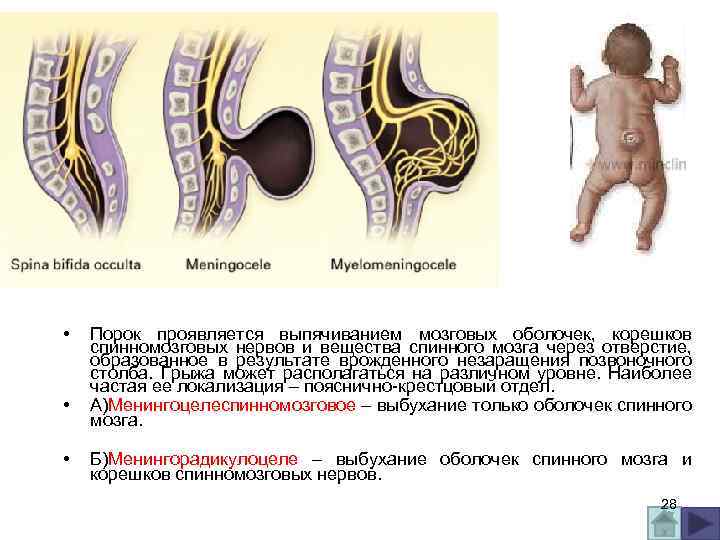  • • • Порок проявляется выпячиванием мозговых оболочек, корешков спинномозговых нервов и вещества