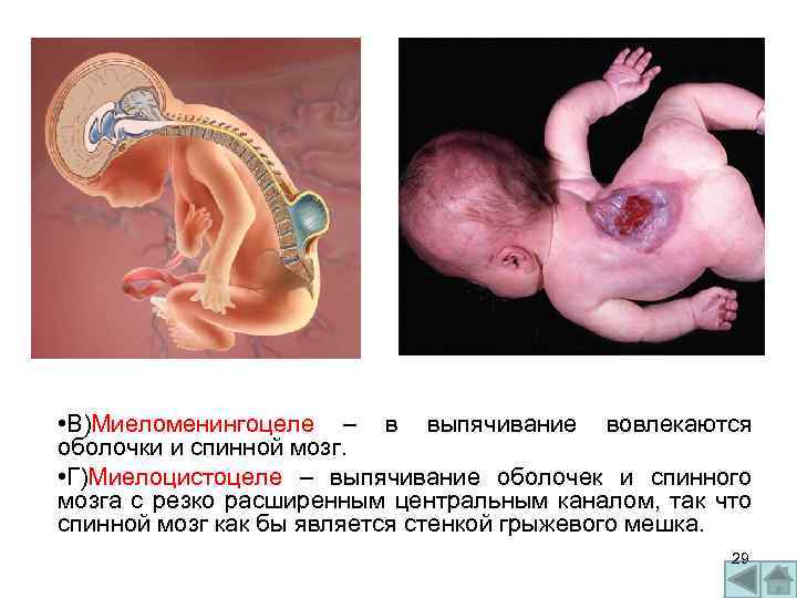  • В)Миеломенингоцеле – в выпячивание вовлекаются оболочки и спинной мозг. • Г)Миелоцистоцеле –