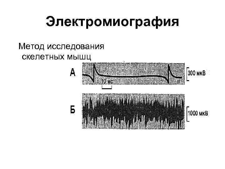 Электромиография Метод исследования скелетных мышц 