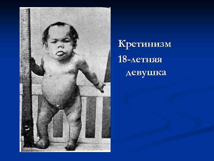 Кретинизм 18 -летняя девушка 