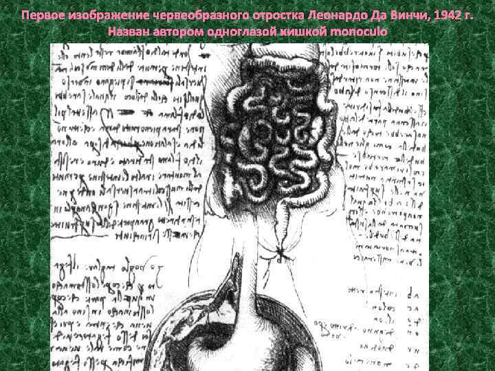Первое изображение червеобразного отростка Леонардо Да Винчи, 1942 г. Назван автором одноглазой кишкой monoculo