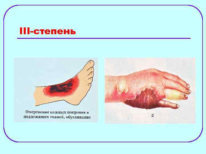 III-степень 