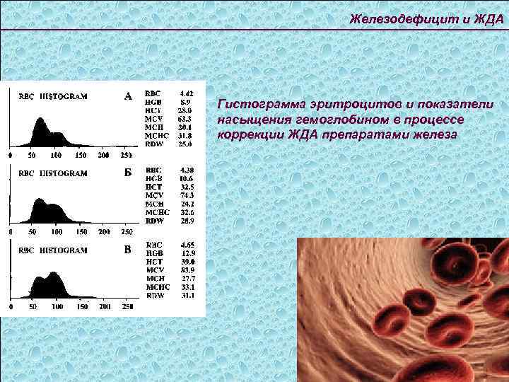 Распределение эритроцитов. Эритроцитарная гистограмма. При железодефицитной анемии эритроцитарная гистограмма. Эритроциты на гистограмме при анемии. Эритроцитарная гистограмма в норме и при патологии.