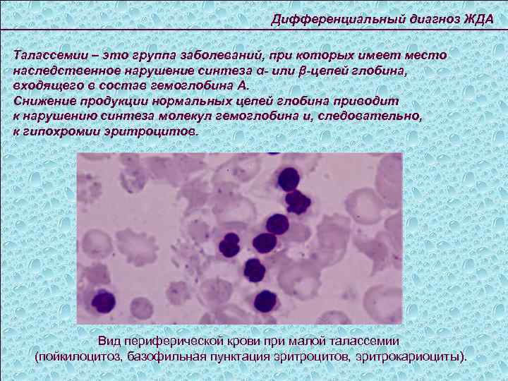 Дифференциальный диагноз ЖДА Талассемии – это группа заболеваний, при которых имеет место наследственное нарушение