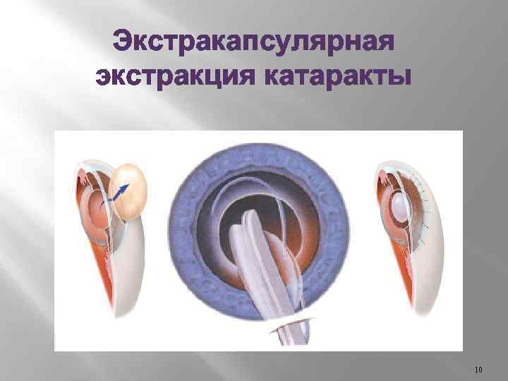 Экстракапсулярная экстракция катаракты 10 