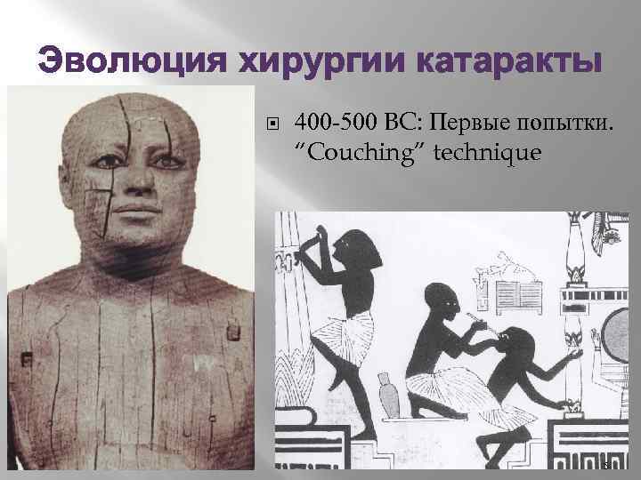 Эволюция хирургии катаракты 400 -500 BC: Первые попытки. “Couching” technique 5 