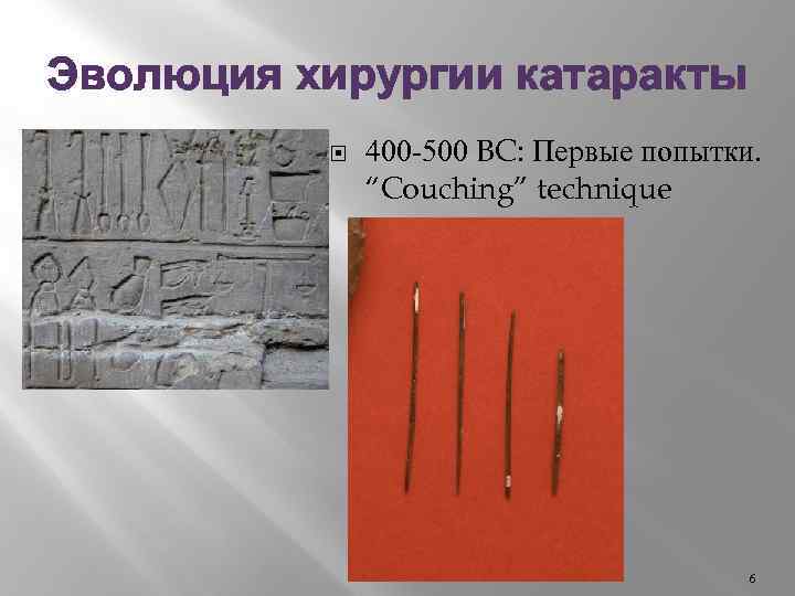 Эволюция хирургии катаракты 400 -500 BC: Первые попытки. “Couching” technique 6 