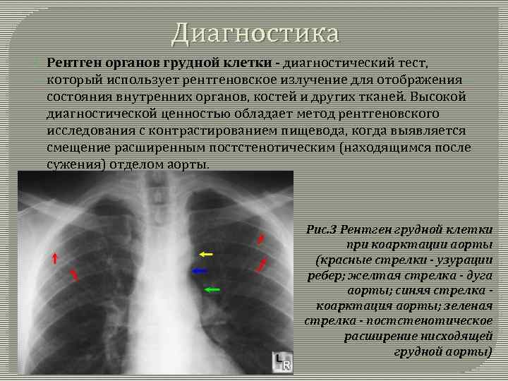 Коарктация аорты гемодинамика схема