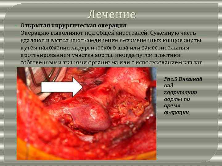 Лечение Открытая хирургическая операция Операцию выполняют под общей анестезией. Суженную часть удаляют и выполняют