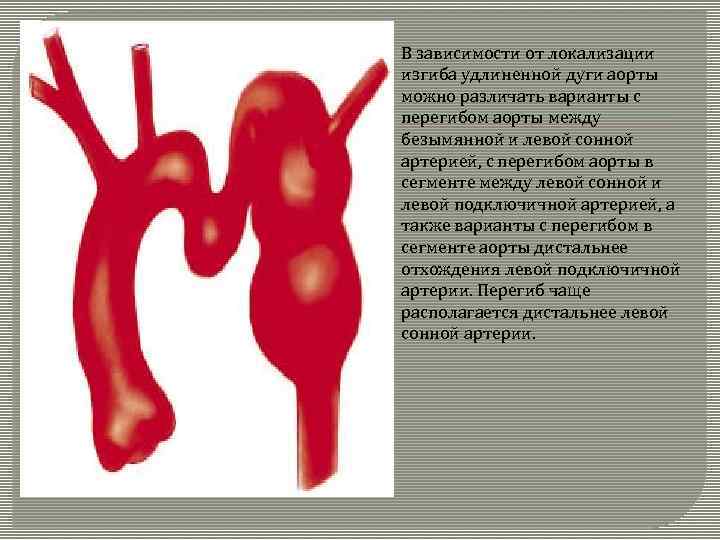 Коарктация аорты картинки