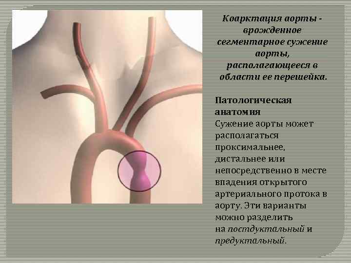 Коарктация аорты - врожденное сегментарное сужение аорты, располагающееся в области ее перешейка. Патологическая анатомия
