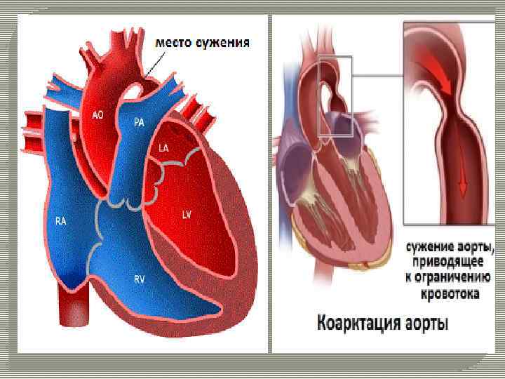 Коарктация аорты картинки