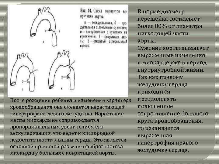 В норме диаметр перешейка составляет более 80% от диаметра нисходящей части аорты. Сужение аорты