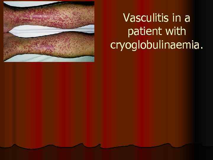 Vasculitis in a patient with cryoglobulinaemia. 