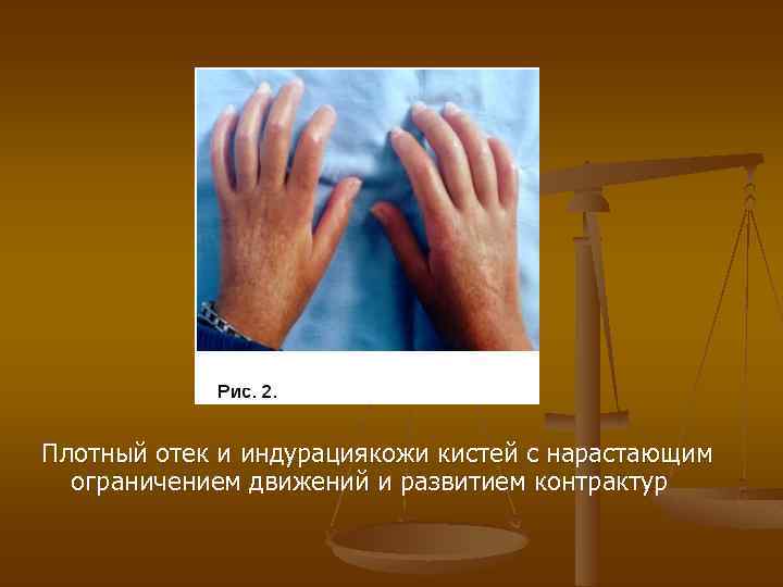 Плотный отек и индурациякожи кистей с нарастающим ограничением движений и развитием контрактур 